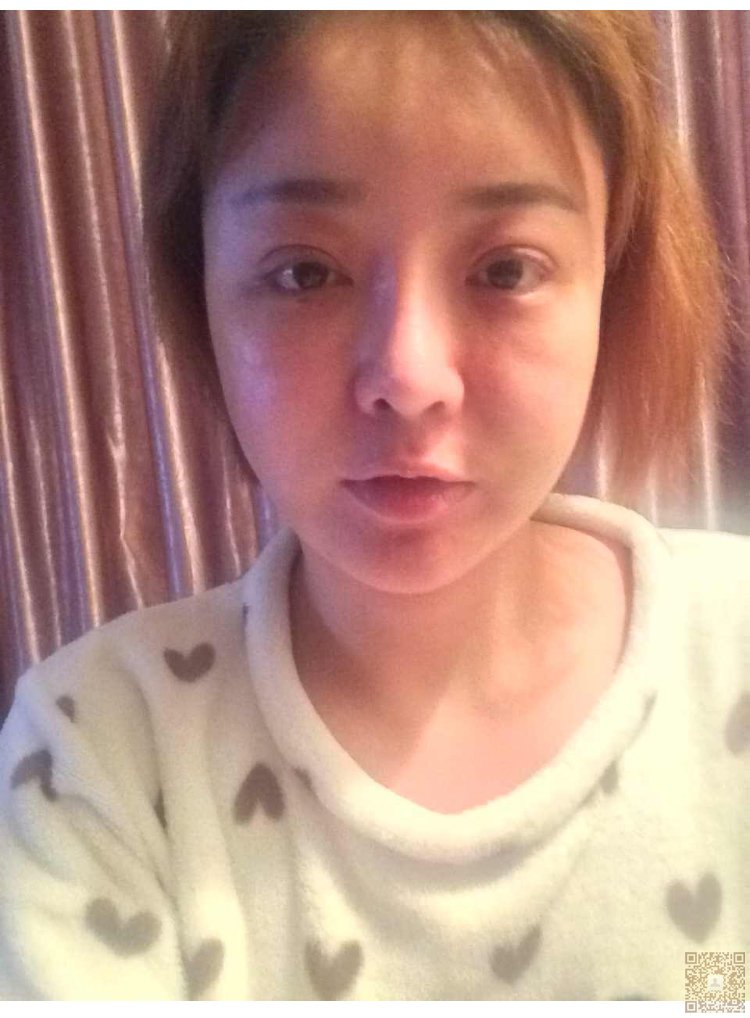 超声波双眼皮还我美美双眼皮939 超声波双眼皮还我美美双眼皮939