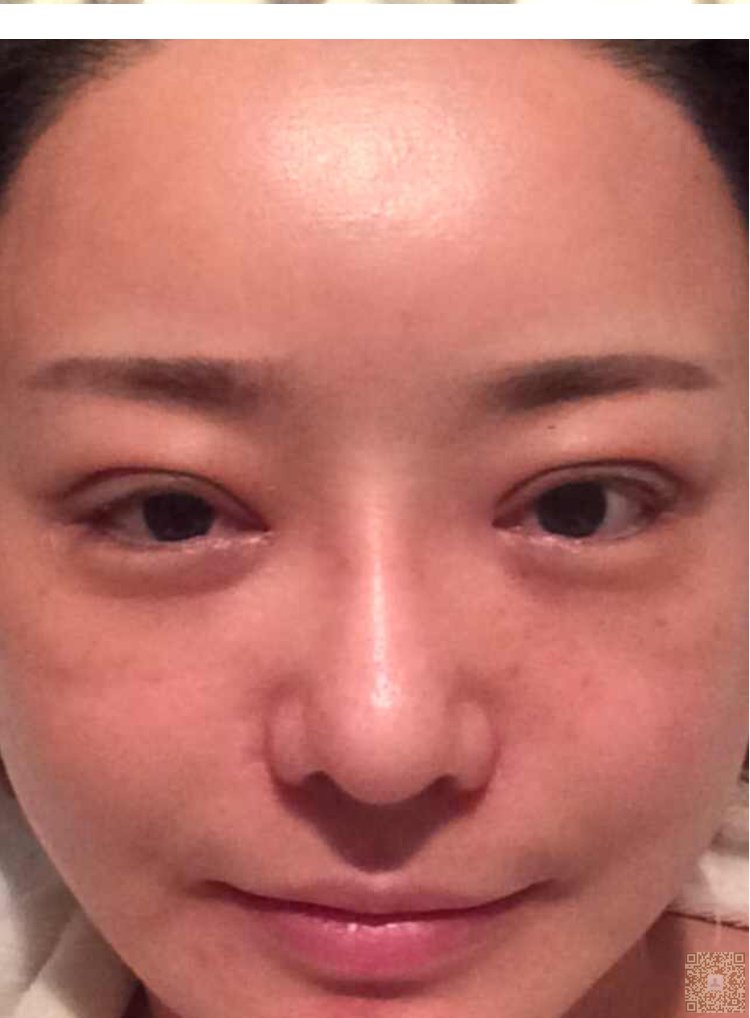 超声波双眼皮还我美美双眼皮939 超声波双眼皮还我美美双眼皮939