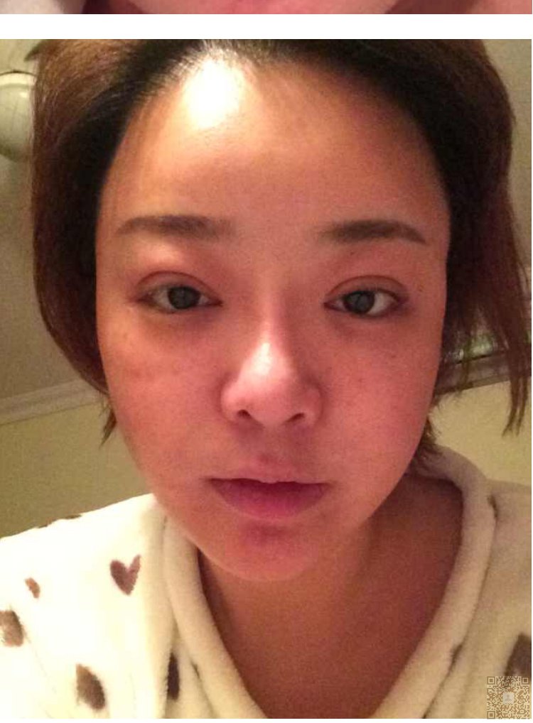 超声波双眼皮还我美美双眼皮939 超声波双眼皮还我美美双眼皮939