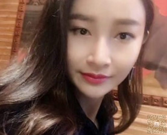 超 声 波双眼 皮得意外收获 超 声 波双眼 皮得意外收获