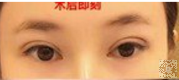超 声 波双眼 皮得意外收获 超 声 波双眼 皮得意外收获