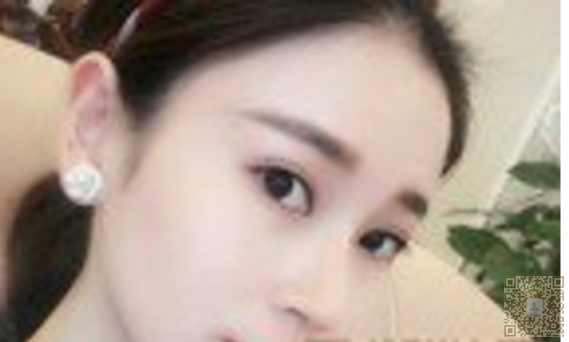 超 声 波双眼 皮得意外收获 超 声 波双眼 皮得意外收获