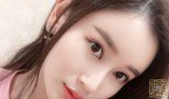 超 声 波双眼 皮得意外收获 超 声 波双眼 皮得意外收获