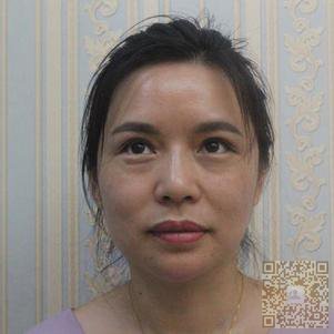 超声波去眼袋手术还我美丽与年轻629 超声波去眼袋手术还我美丽与年轻629