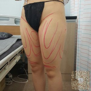 超 声 波减肥手术轻松拥有明星体型 超 声 波减肥手术轻松拥有明星体型