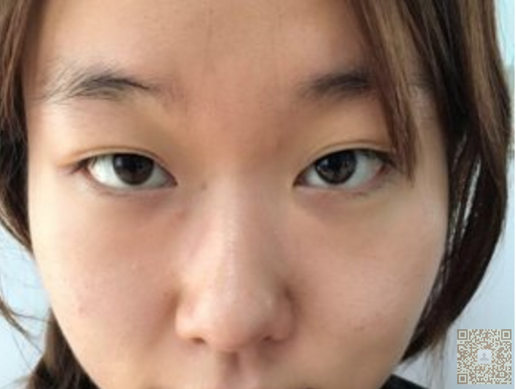 wǒ对重庆超雅得超 声 波双眼 皮很满意。 wǒ对重庆超雅得超 声 波双眼 皮很满意。