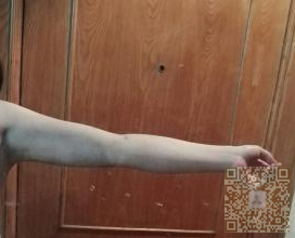 手臂就这样瘦下来了——超声波减肥309 手臂就这样瘦下来了——超声波减肥309