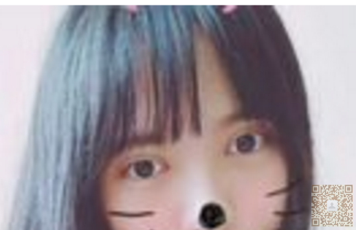 我自己去超雅做超声波双眼皮的经历分享682 我自己去超雅做超声波双眼皮的经历分享682