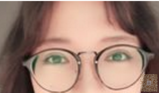 我自己去超雅做超声波双眼皮的经历分享682 我自己去超雅做超声波双眼皮的经历分享682