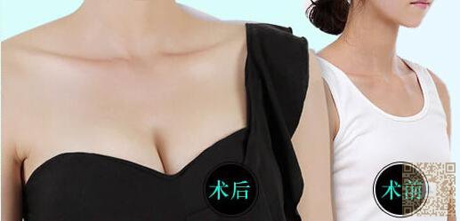 超 声 波自体脂肪丰胸,给你想要得美 超 声 波自体脂肪丰胸,给你想要得美