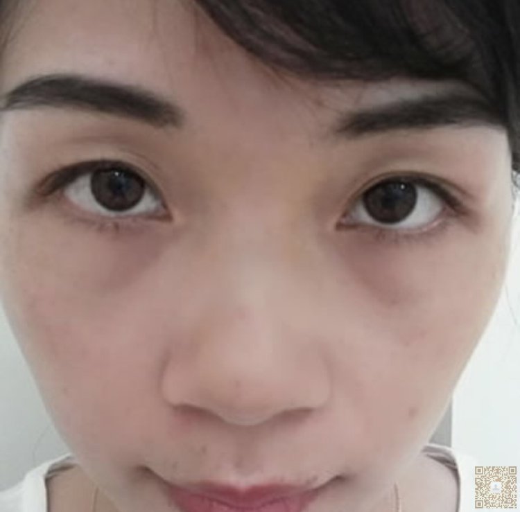 做完超声波去眼袋,我漂亮了很多899 做完超声波去眼袋,我漂亮了很多899