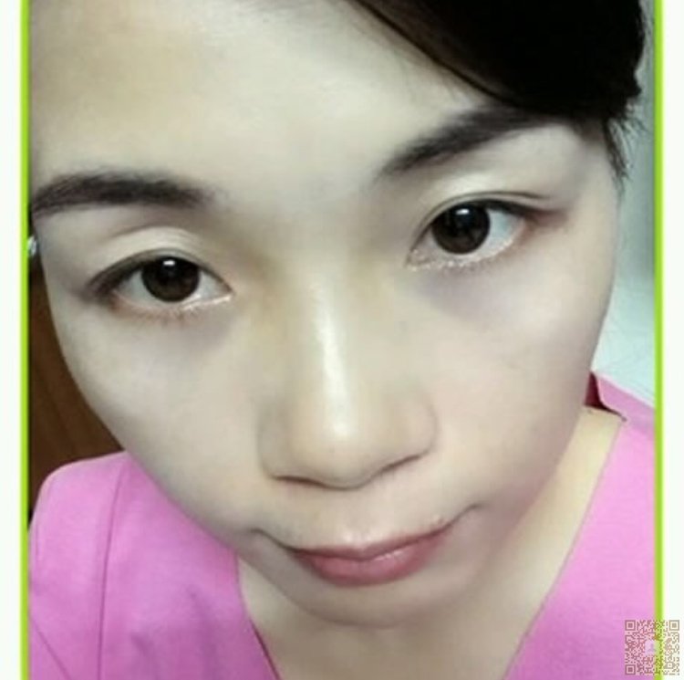 做完超声波去眼袋,我漂亮了很多899 做完超声波去眼袋,我漂亮了很多899