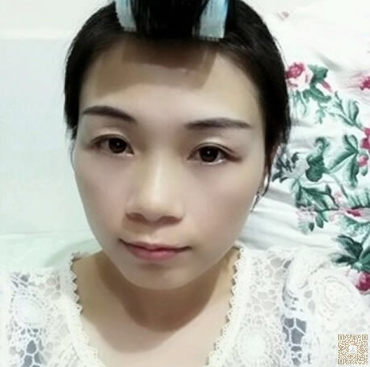 做完超声波去眼袋,我漂亮了很多899 做完超声波去眼袋,我漂亮了很多899