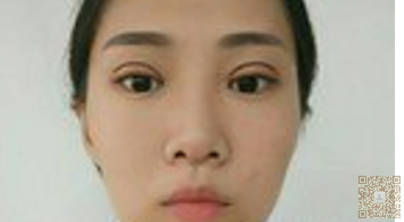 我朋友介绍我去做超声波双眼皮012 我朋友介绍我去做超声波双眼皮012