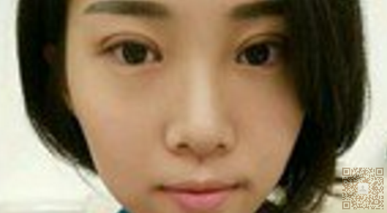 我朋友介绍我去做超声波双眼皮012 我朋友介绍我去做超声波双眼皮012