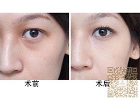 超 声 波祛眼袋改变整体气质 超 声 波祛眼袋改变整体气质