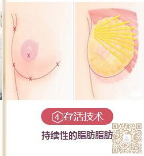 超声波丰胸确保纯天然776 超声波丰胸确保纯天然776