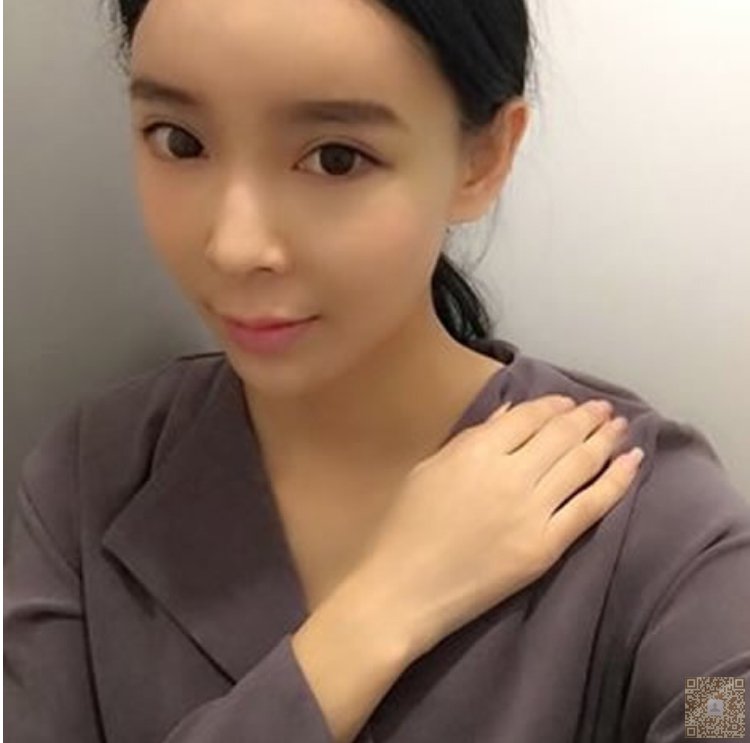 超声波祛眼袋术后无任何不适590 超声波祛眼袋术后无任何不适590