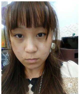 超声波祛眼袋让我回归美丽446 超声波祛眼袋让我回归美丽446