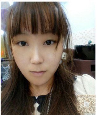 超声波祛眼袋让我回归美丽446 超声波祛眼袋让我回归美丽446