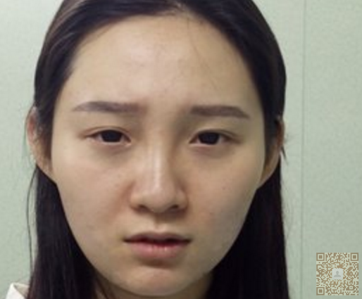 大家都说我做了超声波双眼皮后漂亮了873 大家都说我做了超声波双眼皮后漂亮了873
