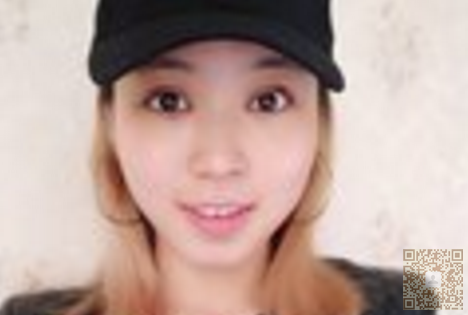 我做超声波双眼皮的亲身经历847 我做超声波双眼皮的亲身经历847