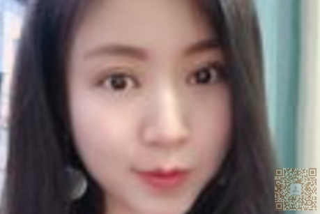 我做超声波双眼皮的亲身经历847 我做超声波双眼皮的亲身经历847