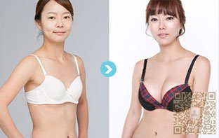超 声 波丰胸得优胜之处 超 声 波丰胸得优胜之处