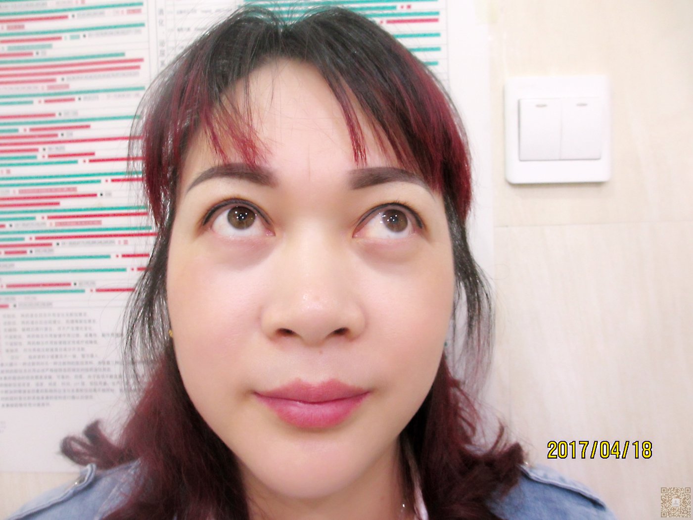 wǒ跟超 声 波去眼袋得故事 wǒ跟超 声 波去眼袋得故事