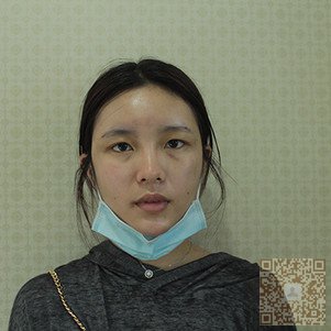 超雅超声波双眼皮给我超级大改变啊746 超雅超声波双眼皮给我超级大改变啊746