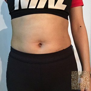 超 声 波减肥让wǒ女性曲线尽显