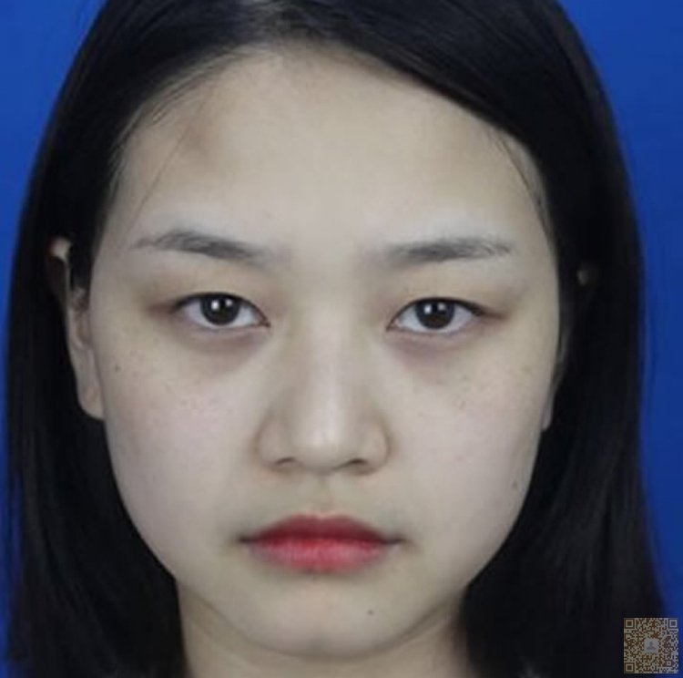 超 声 波双眼 皮,wǒ做完le大家都说wǒ漂亮 超 声 波双眼 皮,wǒ做完le大家都说wǒ漂亮