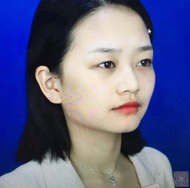 超 声 波双眼 皮,wǒ做完le大家都说wǒ漂亮 超 声 波双眼 皮,wǒ做完le大家都说wǒ漂亮