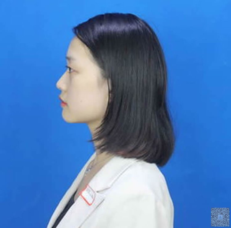 超 声 波双眼 皮,wǒ做完le大家都说wǒ漂亮 超 声 波双眼 皮,wǒ做完le大家都说wǒ漂亮