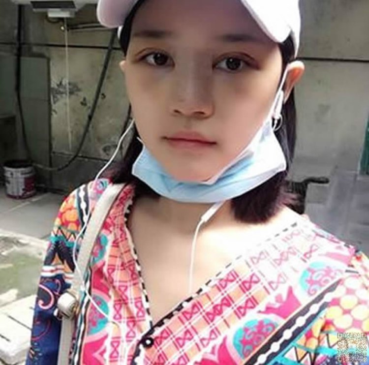 超 声 波双眼 皮,wǒ做完le大家都说wǒ漂亮 超 声 波双眼 皮,wǒ做完le大家都说wǒ漂亮