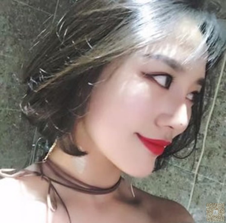 超声波双眼皮拯救了我失败的双眼皮515 超声波双眼皮拯救了我失败的双眼皮515