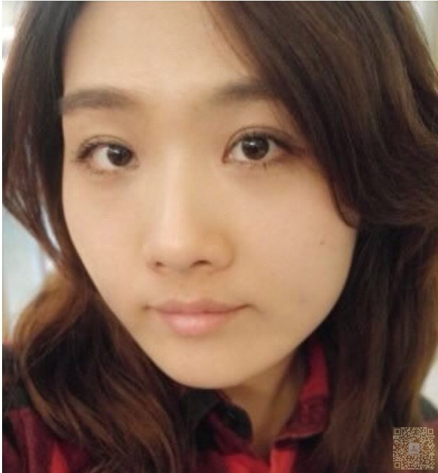 超声波祛眼袋术后不会反弹703 超声波祛眼袋术后不会反弹703