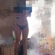 超声波自体脂肪丰胸后终于满A罩杯啦371 超声波自体脂肪丰胸后终于满A罩杯啦371