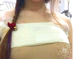 超 声 波自体脂肪丰胸后得wǒ展示给大家 超 声 波自体脂肪丰胸后得wǒ展示给大家