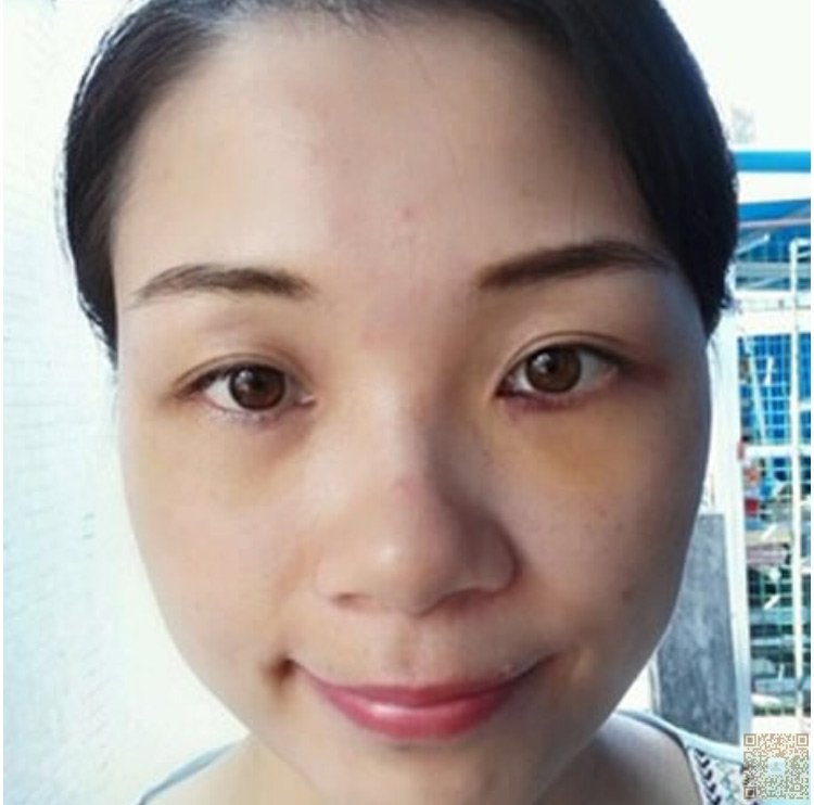 超 声 波祛眼袋只为你ー句很美 超 声 波祛眼袋只为你ー句很美