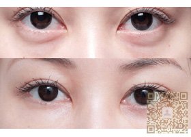 超 声 波祛眼袋只为你ー句很美 超 声 波祛眼袋只为你ー句很美