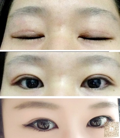 超 声 波双眼 皮自然程度让wǒ震惊
