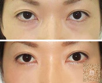 超声波祛眼袋疗效持久304 超声波祛眼袋疗效持久304