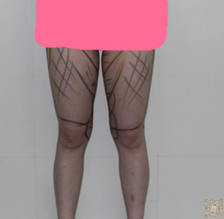 局部瘦超 声 波减肥可以帮到你 局部瘦超 声 波减肥可以帮到你