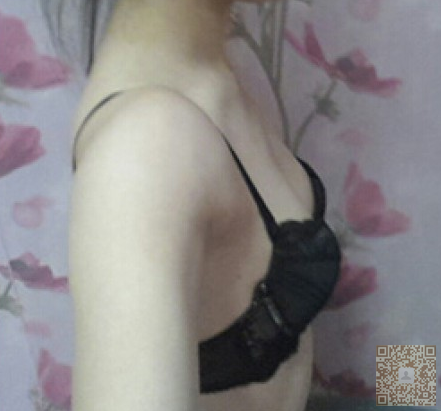 超声波自体脂肪丰胸后终于不用自卑啦803 超声波自体脂肪丰胸后终于不用自卑啦803