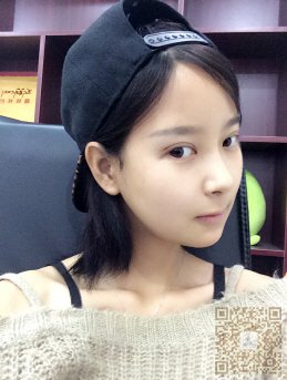 想要变成双眼皮就来到超雅做超声波双眼皮手术吧！733