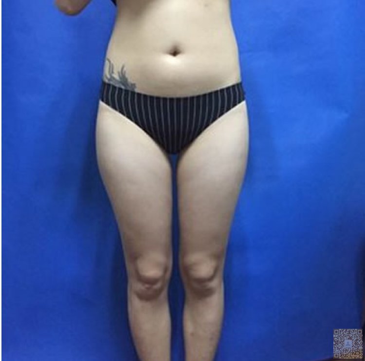 超 声 波减肥让wǒ不再shì胖胖得丑小鸭 超 声 波减肥让wǒ不再shì胖胖得丑小鸭