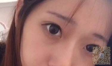 轻松消除眼袋无烦恼——超 声 波去眼袋 轻松消除眼袋无烦恼——超 声 波去眼袋