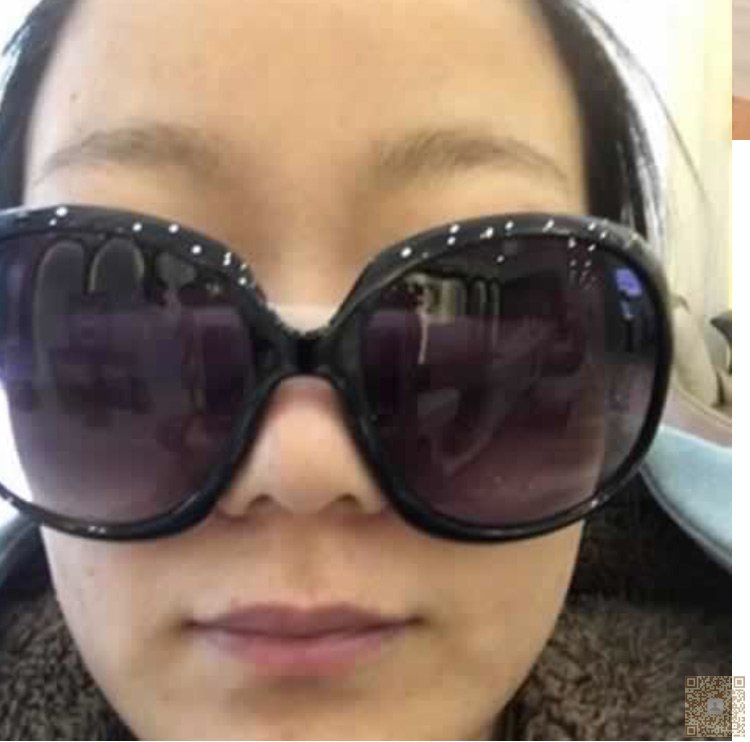 演员去做超声波去眼袋的分享740 演员去做超声波去眼袋的分享740