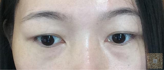 分享一个超级棒的去眼袋手术——超声波去眼袋466 分享一个超级棒的去眼袋手术——超声波去眼袋466